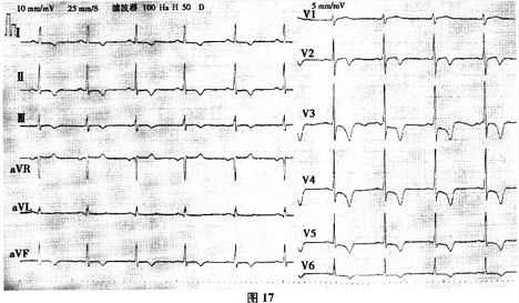  下列哪些表现是心尖肥厚型心肌病特征性心电图表现（）。