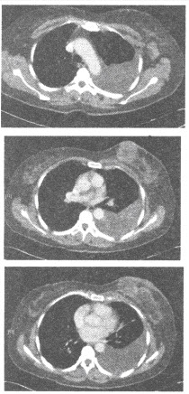 患者，女性，56岁，胸部CT发现乳腺占位性病变，图像如下，以下对该患者乳腺病变较精确的诊断应为（）
