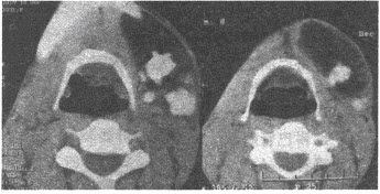男，22岁，半年前无意中发现左颌下肿物。CT表现如图所示，最可能诊断为（）