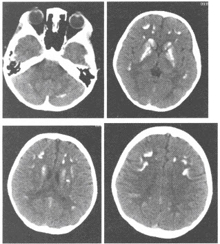 患者，女性，10岁，颅脑CT平扫图像如下，应考虑为（）