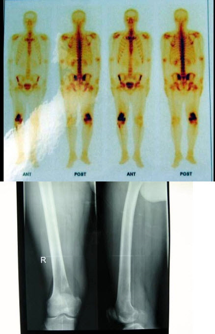 男性，29岁，右侧下肢疼痛3个月，行X线片及骨显像检查，正确的诊断是()