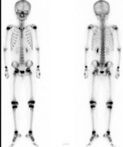 男，8岁，小脑星形胶质细胞瘤术后5个月，未诉不适，行99Tcm-MDP骨显像如图，对此影像描述正确的