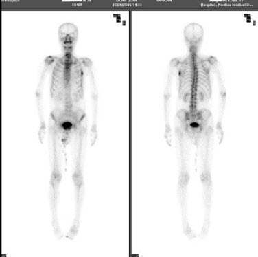 男性78岁，左胸部疼痛1个月，呈间歇性疼痛，CT示左侧胸壁软组织肿块影，对骨显像描述最准确的是()