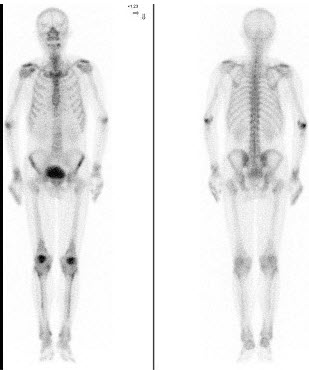 男，69岁，肺癌化疗中，诉下肢疼痛3个月，行全身骨显像如图，可能的诊断()