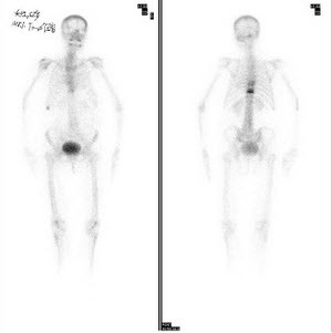 女性，62岁，诉腰背痛1月余，行Tc-MDP骨显像如图，可能的诊断是()