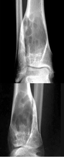 女，26岁，右踝部疼痛，结合图像，最可能的诊断是()