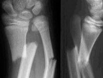 男，10岁，腕部外伤，根据所示图像，最可能的诊断是()