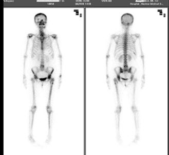 女性，55岁，左大腿上部疼痛3个月，X线片、CT均提示左股骨上段骨囊肿，行全身骨显像如图，最可能的诊