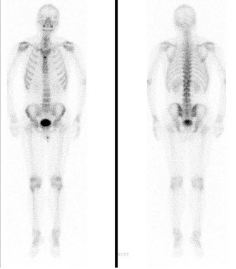男，肝癌术后1年，诉腰背痛5个月，行全身骨显像如图，碱性磷酸酶明显增高，可能的诊断是()