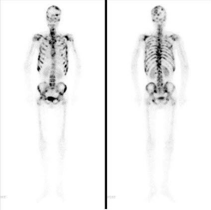 男，48岁，肺小细胞癌化疗中，诉全身疼痛，行全身骨显像如图，可能的诊断是()