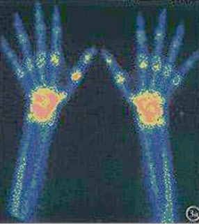 男，56岁，行99Tcm-MDP双手骨显像如图，X线阴性，RF阴性，ESR、CRP稍增高，UA408