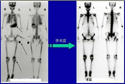 男性38岁，左图为甲状旁腺瘤术前骨显像，右图为3个月后的术后骨显像。正确的描述是()