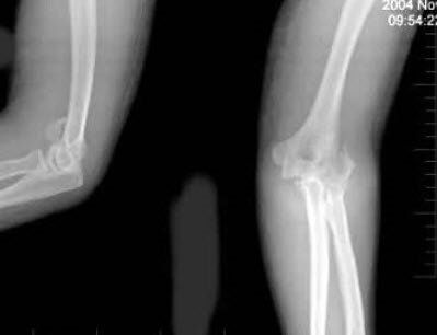 女，53岁，因摔倒时手掌着地，感右肘关节肿痛、畸形，X线摄片如图所示，正确的诊断是()