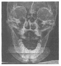 患者，男，33岁，吞咽时感不适，咽痛，转头时疼痛显著，行X线片检查如下，可诊断为（）