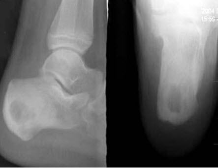 男，13岁，右跟骨疼痛不适3周，右跟骨侧、轴位摄片如图示，最可能的诊断是()