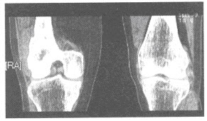 患者，女性，50岁，右股骨下端疼痛2个月余，近期加重，右股骨下端外侧触及软组织肿块。膝关节CT图像如