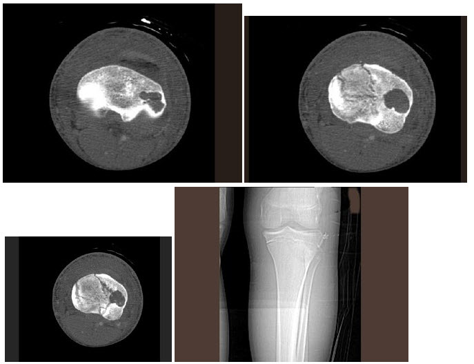 男，16岁，左膝痛，结合图像，最可能的诊断是（）