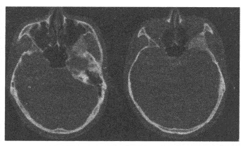患者，男性，21岁，左耳前区不适半年余。CT平扫如下图，最可能的诊断为（）