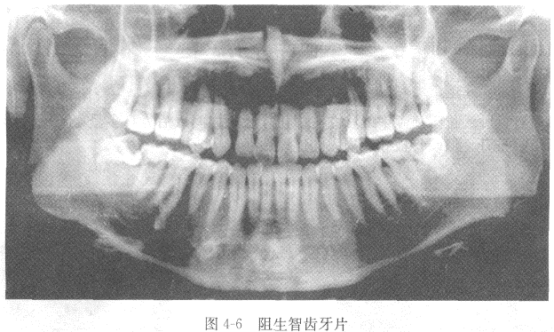 简述阻生智齿牙片（图4-6）[图]...	简述阻生智齿牙片（图4-6）