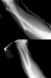 女，27岁，跌倒后左手肿痛，结合X线图像，骨折类型是()
