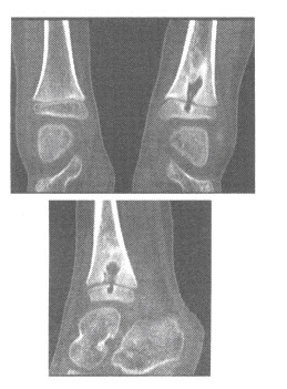 男，5岁，左踝部肿痛2周，CT平扫MPR图像如下，最可能的诊断是（）