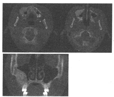 女，12岁，右上颌区硬性肿块。CT图像如下，最可能的诊断为（）