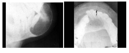 女，40岁，下颌颏部隆起，结合图像最可能诊断（）