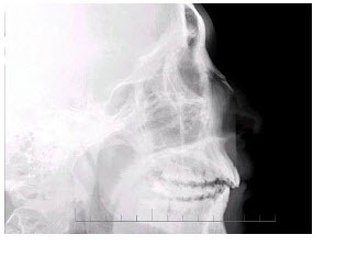 男，24岁，鼻部被击伤，如图所示，最可能的诊断是（）