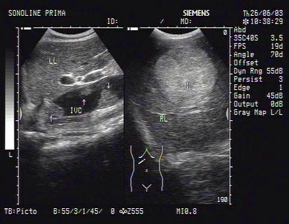 某患者肝脏声像图表现如图，诊断为()