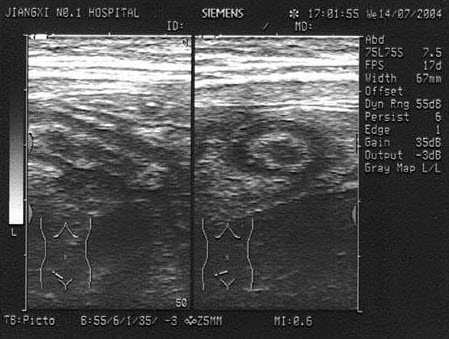 女，54岁。反复便秘，腹泻就诊。PE：左中腹可扪及一肿块，质硬，结节状，OB(Ⅱ)，结合超声声像图，