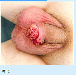 对该患者进一步的处理措施是（）【提示】该患者行阴茎部分切除术后，病理报告：阴茎鳞状细胞癌，T2G3期
