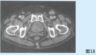 此时较为合理的处理方案是（）【提示】该患者盆腔CT检查图像见图18。