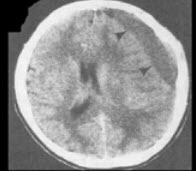 患者，70岁，一周前头部碰到墙，后出现嗜睡2天入院，行头颅CT出现如图所示病变，应诊断为()A. 硬