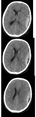 女，11岁，从自行车上摔下，头颅受伤，结合CT图像选择最可能的诊断()