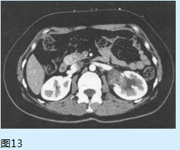 该患者肾盂癌病理分期是（）【提示】患者尿脱落细胞学检查发现癌细胞。膀胱镜检查：膀胱内黏膜光整，血管纹