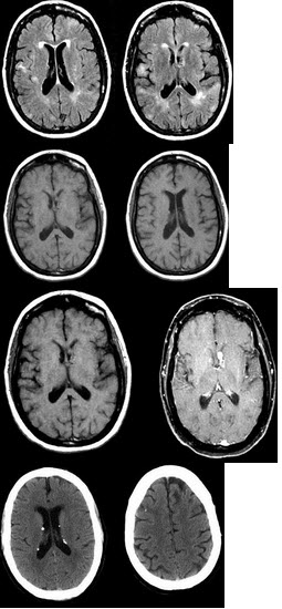 男性，31岁，头痛间歇性发作一年余，CT、MR检查如图，最可能的诊断是()