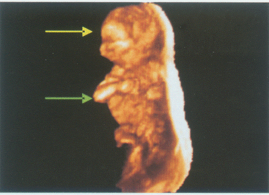 临床资料：女，27岁，孕12周。超声综合描述：图1：宫内可见8.8cm×3.2cm孕囊，内胎儿头臀长