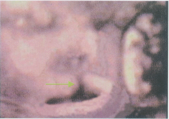 临床资料：女，26岁，孕36周。超声综合描述：采用三维表面成像技术扫查：清楚显示胎儿头面部，请回答下