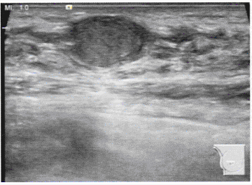 患者，女性，25岁，1个月前发现右乳包块，查体该包块可滑动。声像图见下图，图中所示为（）。