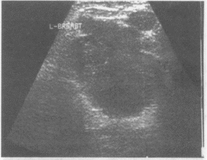 临床资料：女，42岁，查体时发现左乳腺一肿物，活动度差，质硬。超声综合描述：左乳外上象限可见4.1c