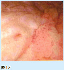 	下列关于BCG灌注描述正确的是（）A. 对于低危非肌层浸润膀胱尿路上皮癌不建议行BCG灌注治疗B.