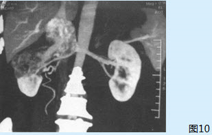 该患者还需行下列哪些检查（）【提示】患者行增强CT加三维重建检查（图10），提示右肾癌伴下腔静脉瘤栓