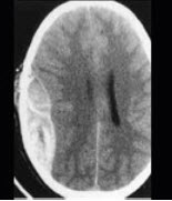 男性，50岁，摔跤后出现头痛2天入院，行头颅CT出现如图所示病变，应诊断为()A. 硬膜外出血B. 