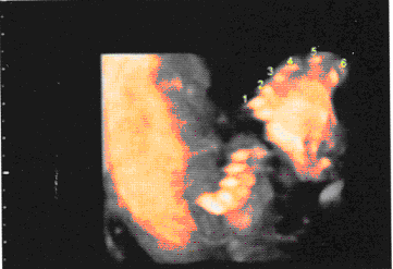 胎儿超声检查如图，最可能的诊断是（）。