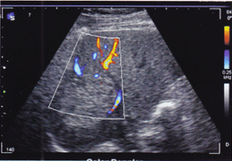 患者，男性，体检发现右肝稍增强回声，边界尚清，CDFI：内部可见点状血流信号，周边可见环绕状血流。患