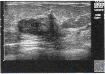 患者，女性，45岁，1个月前发现左乳包块，查体该包块质硬。声像图见下图，图中所示为（）。