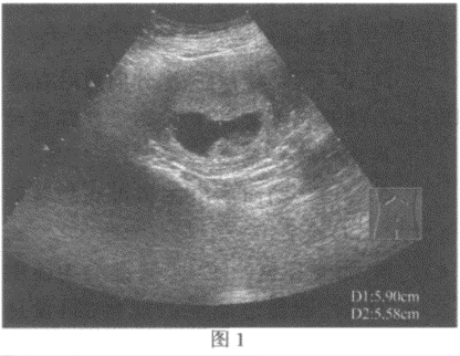 临床资料：女，25岁；孕9周。超声综合描述：图1：宫内可见5.0cm×2.6cm孕囊，内见胎芽及胎心