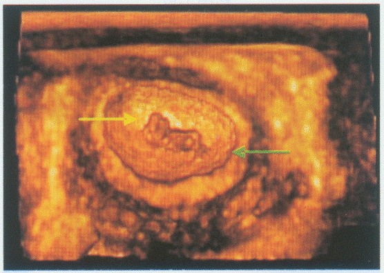 临床资料：女，25岁；孕9周。超声综合描述：图1：宫内可见5.0cm×2.6cm孕囊，内见胎芽及胎心