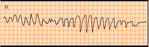 一女性冠心病患者，63岁，血钾低，现发作晕厥，心电图如下，诊断考虑()