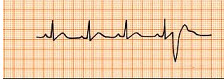 心电图所示为()